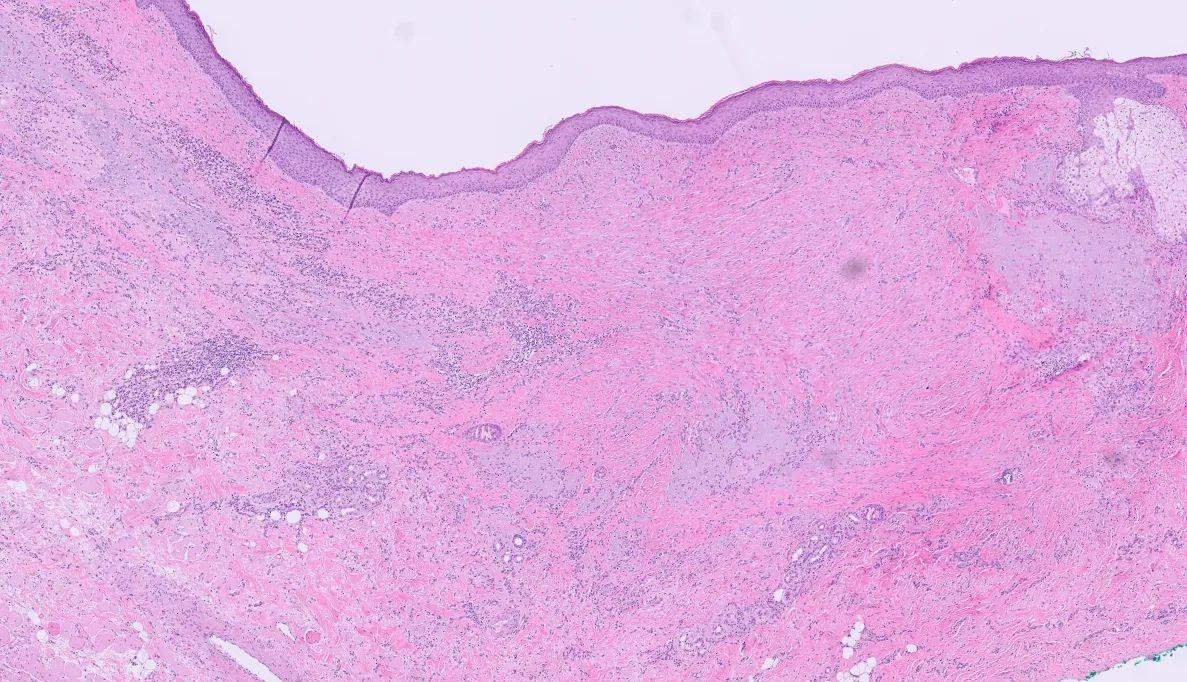 JoanaPath's tweet photo. 83y male with a lesion on his nose (scar? desmoplastic melanoma?). There's a melanocytic nest in the dermis and inflammation and foreign body reaction but there is no record of previous excisions in this location. No mitosis. I really need some advise :) @JMGardnerMD https://t.co/vvzMkReXNF