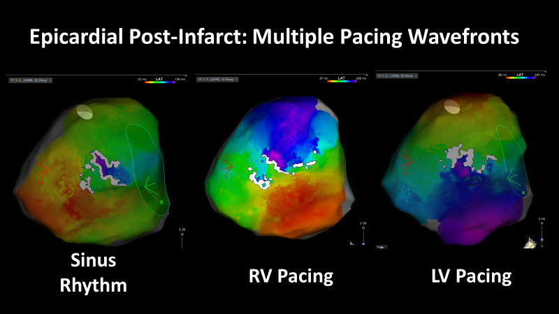 Timothy Maher, MD (@timothymahermd1) on Twitter photo Nice redo post-infarct case - given prior inferior infarct we explored the epicardial space and found nice WADLs and channels seen from multiple points of view: sinus, RV pacing, and LV pacing. @davilandre, <a href="/fritzstabenau/">Fritz Stabenau</a> , <a href="/BIDMC_VT/">BIDMC VT Center</a> , #ablateVT Nice redo post-infarct case - given prior inferior infarct we explored the epicardial space and found nice WADLs and channels seen from multiple points of view: sinus, RV pacing, and LV pacing. @davilandre, <a href="/fritzstabenau/">Fritz Stabenau</a> , <a href="/BIDMC_VT/">BIDMC VT Center</a> , #ablateVT