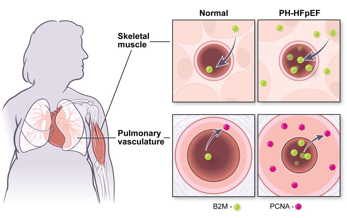 ATVB: An AHA Journal (@atvbahajournals) on Twitter photo Not just a loading control. Circulating and skeletal muscle B2M correlate with PH-HFpEF severity and
contributes to the pathogenesis of the disease <a href="/MarcSimonMD/">MarcSimonMD</a> <a href="/JTDesJardin/">Jackie DesJardin, MD</a>
<a href="/Baiyang2022/">Yang</a> @ATVB <a href="/iuc453/">Charly Lai</a>
ahajrnls.org/3VEAfs2 Not just a loading control. Circulating and skeletal muscle B2M correlate with PH-HFpEF severity and
contributes to the pathogenesis of the disease <a href="/MarcSimonMD/">MarcSimonMD</a> <a href="/JTDesJardin/">Jackie DesJardin, MD</a>
<a href="/Baiyang2022/">Yang</a> @ATVB <a href="/iuc453/">Charly Lai</a>
ahajrnls.org/3VEAfs2