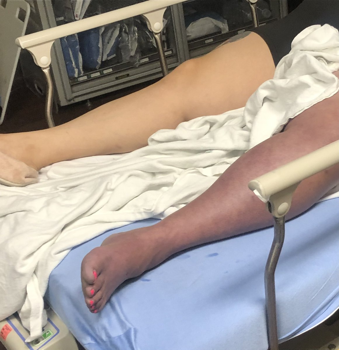 Preston George Smith (@drprestongs) on Twitter photo Saw the most legit phlegmasia case of my life recently. Sensory+motor function loss reversed with single session thrombectomy. Can you believe we were doing this with 5-6 F devices a decade ago?! <a href="/SIRspecialists/">Society of Interventional Radiology</a> <a href="/VascularSVS/">Vascular SVS</a> <a href="/EVToday/">Endovascular Today</a> <a href="/_backtable/">BackTable Vascular and Interventional</a> <a href="/VIR_RUSH/">VIR at RUSH</a> <a href="/MCWVascSurg/">MCW Vascular and Endovascular Surgery</a> <a href="/MCW_VIR/">MCW VIR</a> Saw the most legit phlegmasia case of my life recently. Sensory+motor function loss reversed with single session thrombectomy. Can you believe we were doing this with 5-6 F devices a decade ago?! <a href="/SIRspecialists/">Society of Interventional Radiology</a> <a href="/VascularSVS/">Vascular SVS</a> <a href="/EVToday/">Endovascular Today</a> <a href="/_backtable/">BackTable Vascular and Interventional</a> <a href="/VIR_RUSH/">VIR at RUSH</a> <a href="/MCWVascSurg/">MCW Vascular and Endovascular Surgery</a> <a href="/MCW_VIR/">MCW VIR</a>