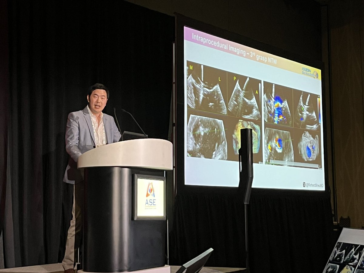 Enrique Garcia-Sayan, MD, FACC, FASE (@egarciasayan) on Twitter photo <a href="/RichardSheuMD/">Richard Sheu</a> presents a challenging secondary MRI TEER case at #ASE2024. Gradient jumps to >10 mmHg post grasp in patient with a an otherwise generous MVA. Strategies to manage increased gradient, device choice, how much gradient is acceptable? <a href="/RichardSheuMD/">Richard Sheu</a> presents a challenging secondary MRI TEER case at #ASE2024. Gradient jumps to >10 mmHg post grasp in patient with a an otherwise generous MVA. Strategies to manage increased gradient, device choice, how much gradient is acceptable?