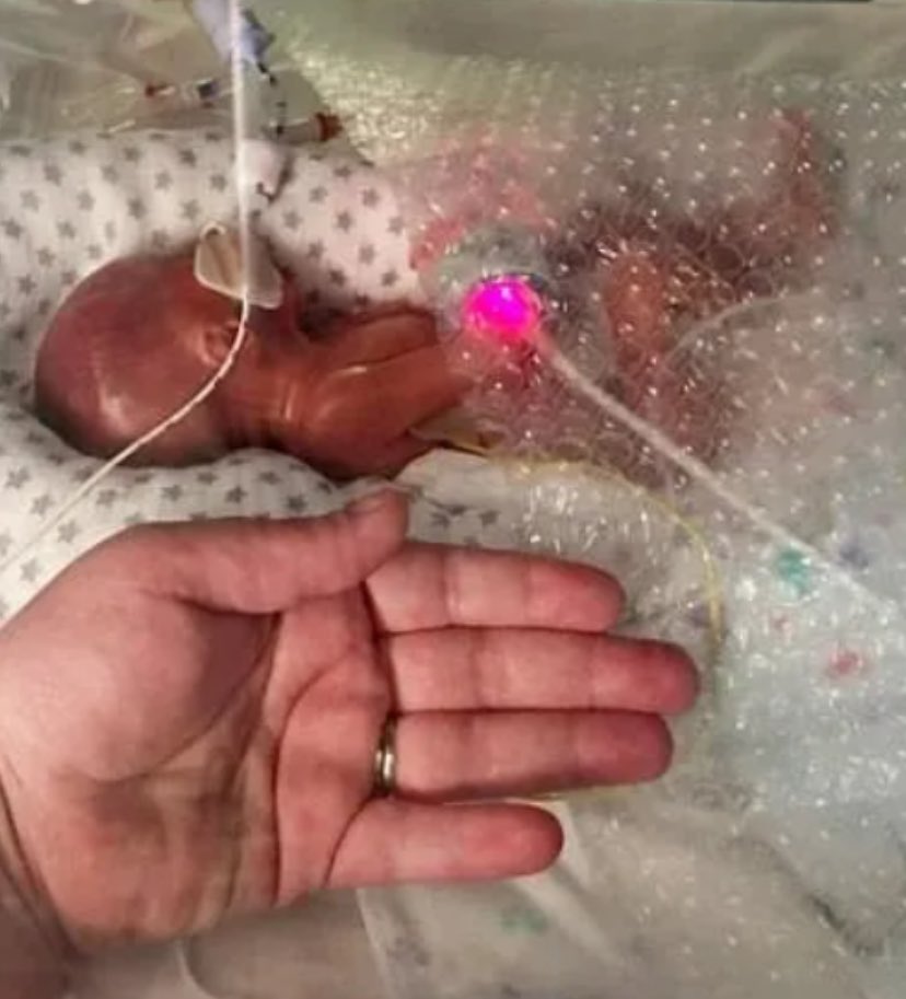 enf_intensiva's tweet photo. Refutando essa MENTIRA
Um feto de 22 semanas não sobrevive se não houver atenção médica especializada IMEDIATA, e mesmo nessa condição as chances de sobrevivência são de 2- 15%. Os pulmões ainda não estão maduros o suficiente para que ele sobreviva fora do útero, a menos que seja INTUBADO por um médico ESPECIALISTA em Neonatologia. 
A Direita não se mantém se não houver mentiras