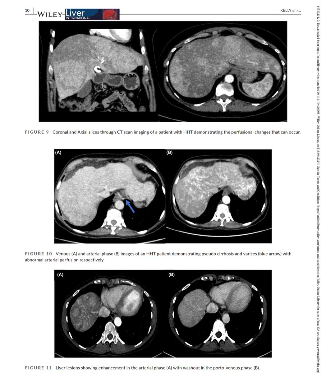 Elliot Tapper (@ebtapper) on Twitter photo Here is a terrific review on hereditary hemorrhagic telangectasia and the liver
1. Physiology
2. Complications
3. Role of bevacizumab
Claire Kelly in <a href="/LiverInt/">Liver International</a> doi.org/10.1111/liv.16… Here is a terrific review on hereditary hemorrhagic telangectasia and the liver
1. Physiology
2. Complications
3. Role of bevacizumab
Claire Kelly in <a href="/LiverInt/">Liver International</a> doi.org/10.1111/liv.16…