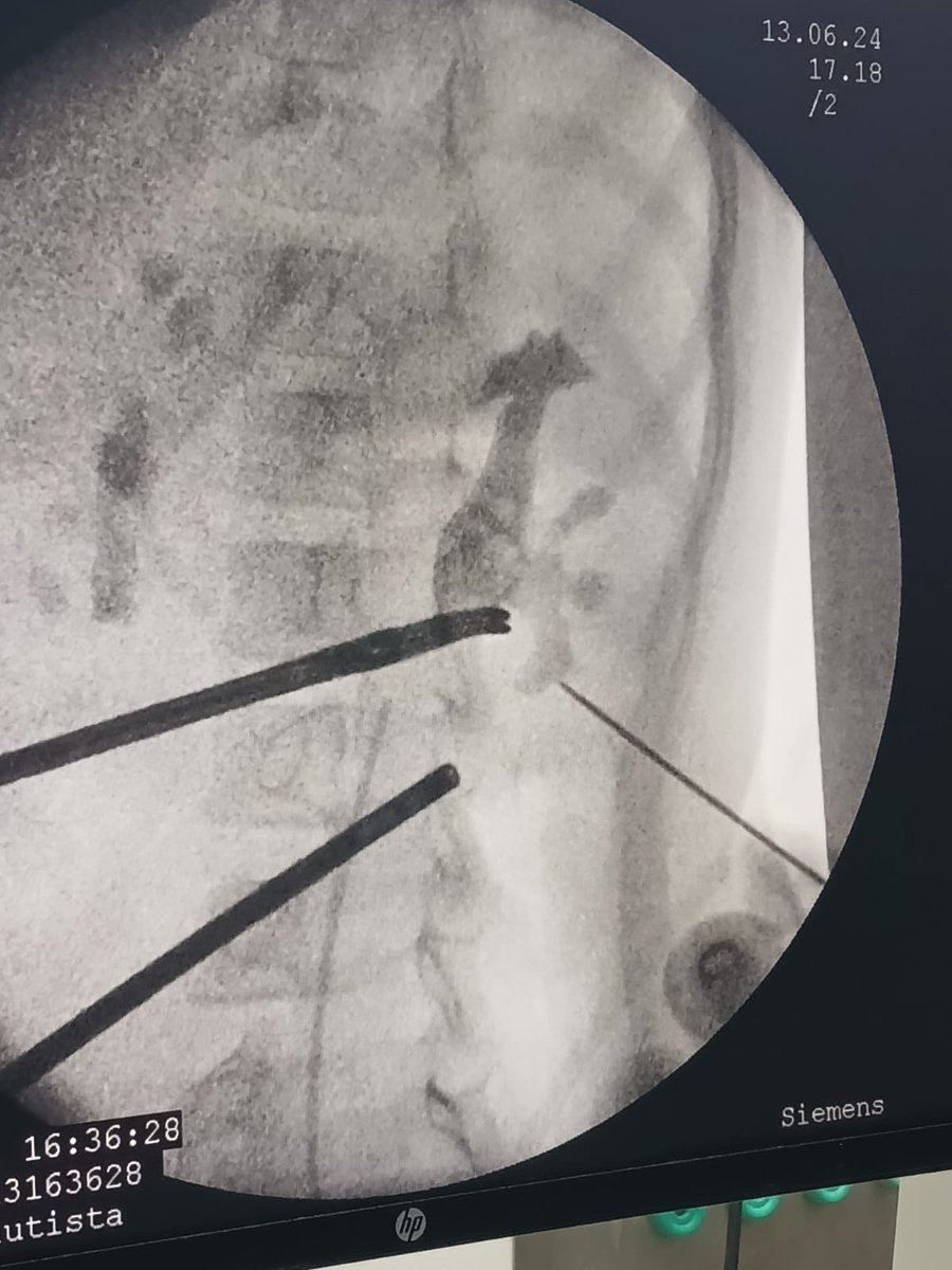 Skonrado's tweet photo. Femenina 6 años Coraliforme Guy IV #miniperck #urologia #urology #litiasisrenal #endourologia #nicaragua https://t.co/rOduWZHoVI