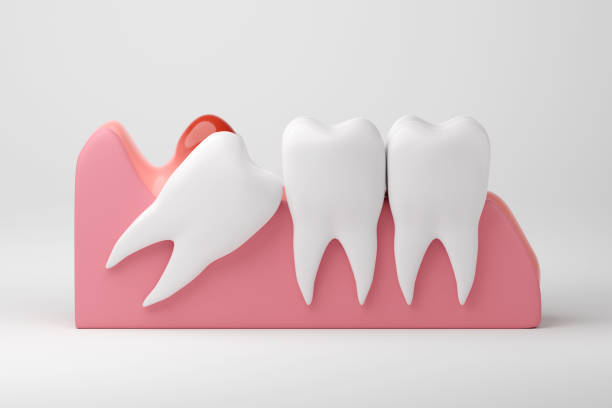 Wisdom teeth often cause problems as they are the last to emerge and may not have enough room to grow properly. Regular dental check-ups can help monitor their progress and prevent potential issues. #WisdomTeeth #DentalCare