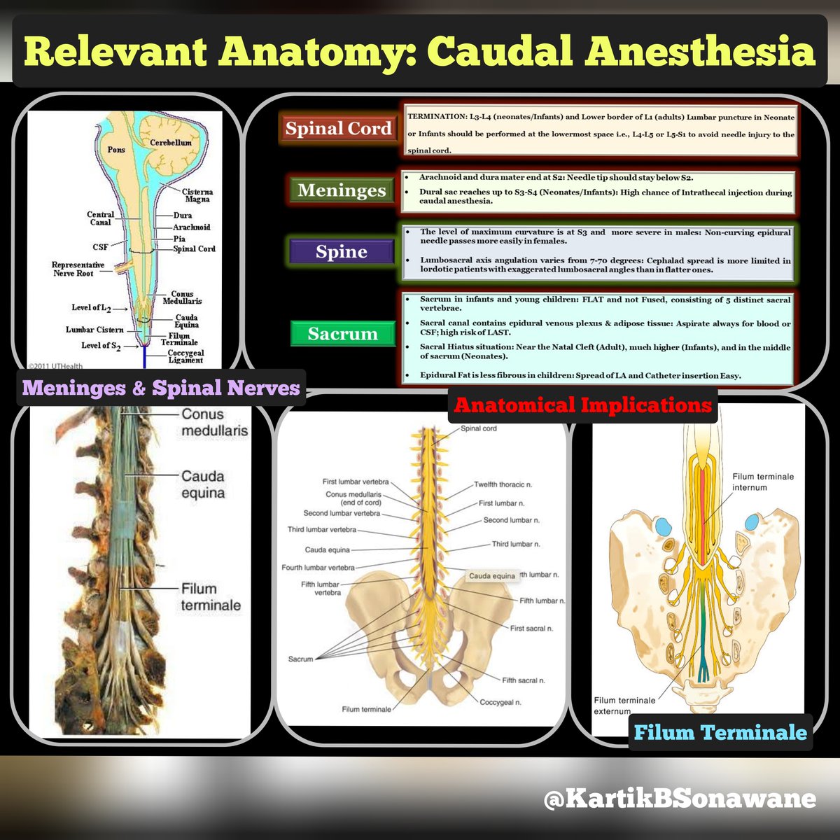“Mastering Caudal Anesthesia: Techniques and Insights”

Discover the precision of Caudal Anesthesia!

Elevating pediatric care with advanced techniques for effective pain management. 

Learn about indications, relevant anatomy, and cutting-edge methods like ultrasound and