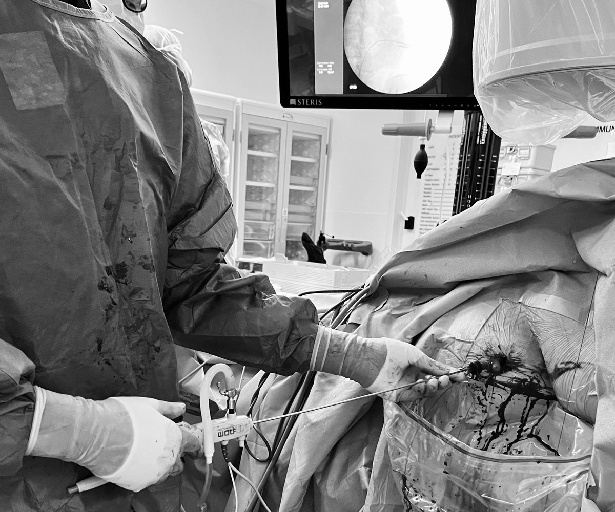 John Michael DiBianco (@drjohnmdibi) on Twitter photo #ECIRS suction assisted #miniPCNL in a super morbid obese patient requiring long <a href="/ClearpetraL/">ClearPetra-Well Lead</a> sheath. Unique and helpful application of the <a href="/richardwolfusa/">richardwolfusa</a> #RIWODURS scope given its length and mobility
<a href="/UF_Urology/">UF Urology</a> #UroGators #ABH #clearpetra #ECIRS suction assisted #miniPCNL in a super morbid obese patient requiring long <a href="/ClearpetraL/">ClearPetra-Well Lead</a> sheath. Unique and helpful application of the <a href="/richardwolfusa/">richardwolfusa</a> #RIWODURS scope given its length and mobility
<a href="/UF_Urology/">UF Urology</a> #UroGators #ABH #clearpetra