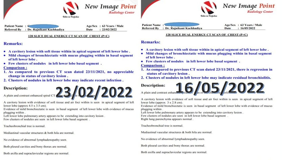 Rajnikant0257's tweet photo. ***AYURVED & Pulmonary Fungal cavitary lesions(Aspergillosis)
***

People and modern medicine doctors who think that Ayurveda is Psudoscience and Ayurveda doctors are doing fraud and we are killing the patients ,must see this case...
The modern medicine doctor advised surgery to remove the part of the lung but Got significant improvement with Ayurvedic treatment without doing any surgery.

⏭️It was a fatal disease and surgical removal of the damaged part of the lung was the only option available to modern medical science, but through Ayurveda treatment, the patient recovered without surgery.

⏭️This patient got Corona in 2021 and after 1 month of his treatment, the patient started complaining of difficulty in breathing and cough and sometimes there was blood in the sputum. And a CT scan revealed that this patient has a fungal infection in the lungs.

⏭️So that the appropriate treatment for this disease was started and medicine was given by anti-fungal injection and oral anti-fungal as well, but even after few days of treatment, the patient did not get any relief and his condition got worsened, the doctor advised immediate lung operation and said that the part in which a fungal infection is there, it has to be removed by operation(Lobectomy).

⏭️During this time someone advised him to take Ayurveda treatment and brought the patient to me and started Ayurveda treatment and gradually the patient got relief.

⏭️CT scan was done at every 2 to 3 months and it was showing improvement in CT scan also, and after approximately 8 months of treatment the patient got 100% relief.

⏭️Note: - This patient was given only Ayurveda treatment and without any modern treatment and without surgery of the lungs, he became completely healthy.

#Ayurveda 
#MedX 
@anandrai177 @DrRamOfficial @moayush @Drnesari @tnesari @AIIA_NDelhi @secymoayush @drkeithsiau @DrSarvapriya @thoughtruminant @VaidyaPraka @LostTemple7 @satnamsandhuchd @savitha_rao @ZankhanaBuch @VTankha @elonmusk