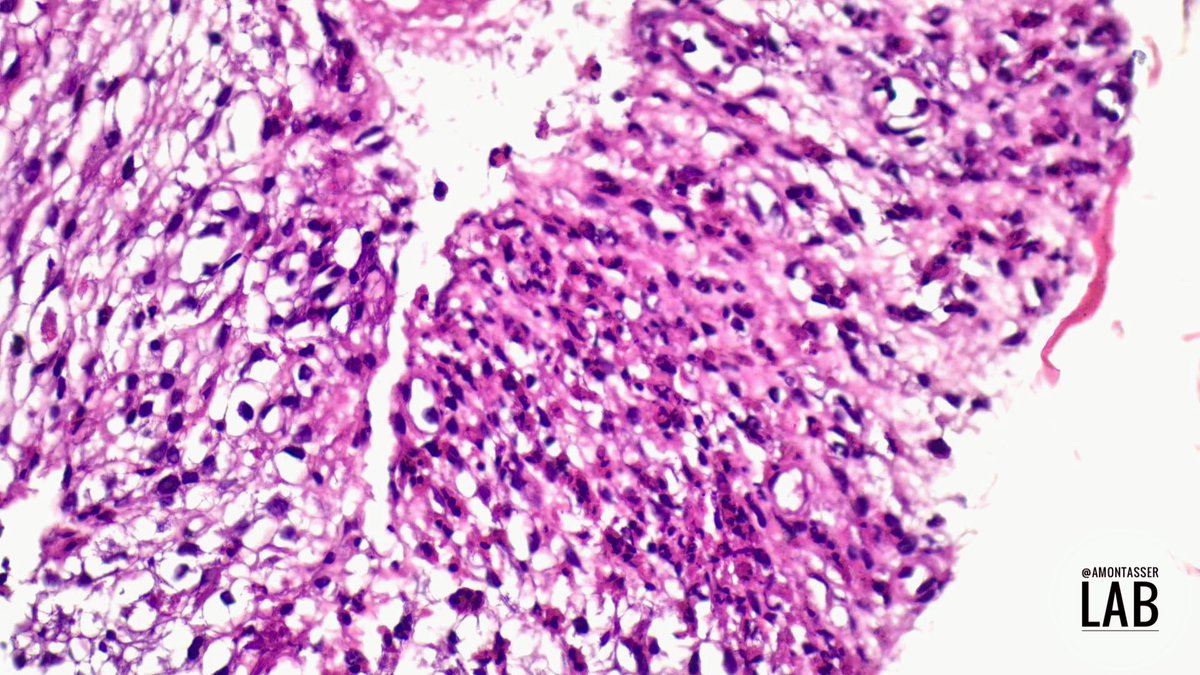 Weekend and Eid vacation so time for an easy #PathGame 🎱

Created this cellblock of EUS-FNB material obtained from a lower esophageal / cardia submucosal swelling of < 3 cm. 

I made my mind on HE, and ordered 3 immunostains for confirmation ; alphabetically CD34, KIT and SMA 🤓