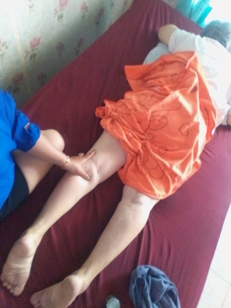 เวลาเดินมีอาการขัดที่หัวเข่าเสียวแปล๊บที่เข่างอเข่าลำบากนั่งยองๆไม่ได้เดินนานหรือเดินที่ต่างระดับจะมีอาการขัดและเสียวแป๊บที่หัวเข่าสนใจมานวดได้นะคะชั่วโมงละ 400 บาทถ้าคิดว่าแพงไปซื้อยากินถ้าคิดว่าแพงไปหาหมอให้หมอผ่าผังผืดที่หัวเข่าไม่ต้องนวดทนเจ็บทนปวดต่อไปแค่นั้นจบ