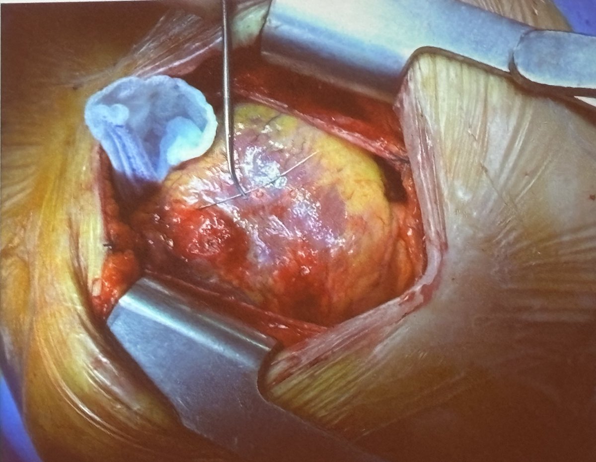 Gary Huang, MD (@garyshuang) on Twitter photo Fascinating multimodality case presented by Dr. Badano of a psychiatric patient who presented with NSTEMI, found to have placed needles through her chest wall into her heart
<a href="/ASE360/">American Society of Echocardiography</a> #ASE2024 #CardioTwitter #CardioEd Fascinating multimodality case presented by Dr. Badano of a psychiatric patient who presented with NSTEMI, found to have placed needles through her chest wall into her heart
<a href="/ASE360/">American Society of Echocardiography</a> #ASE2024 #CardioTwitter #CardioEd