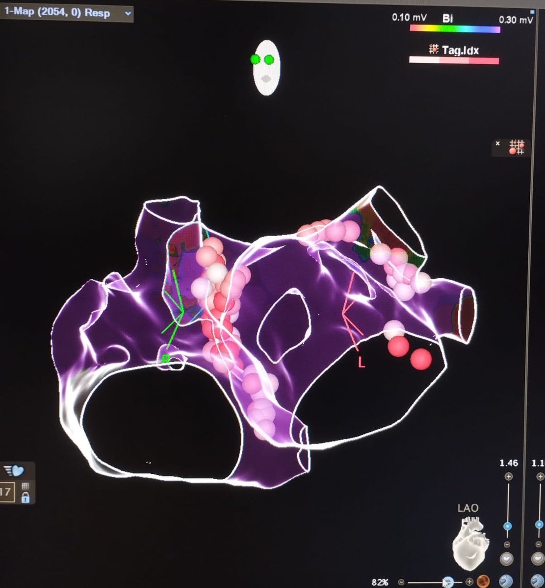 Nicolás Martinenghi (@nicolsmartinen2) on Twitter photo Cardioneuroablation at Sanatorio Trinidad Quilmes. ICE guided. Male, with recurrent & very frequent Cardioinhibitory VV Syncope. Great case with our EP team, Electrofisiologia Buenos Aires. <a href="/ariel/">Ariel Poler</a> estevez <a href="/Capcardio/">Carlos Perona</a> <a href="/maxiayerbe/">Maxiayerbe</a> <a href="/PabloRomeroEP/">pablo Romero</a> #Epeep <a href="/jczerpa/">JC ZERPA</a> @BiosenseWebster Cardioneuroablation at Sanatorio Trinidad Quilmes. ICE guided. Male, with recurrent & very frequent Cardioinhibitory VV Syncope. Great case with our EP team, Electrofisiologia Buenos Aires. <a href="/ariel/">Ariel Poler</a> estevez <a href="/Capcardio/">Carlos Perona</a> <a href="/maxiayerbe/">Maxiayerbe</a> <a href="/PabloRomeroEP/">pablo Romero</a> #Epeep <a href="/jczerpa/">JC ZERPA</a> @BiosenseWebster