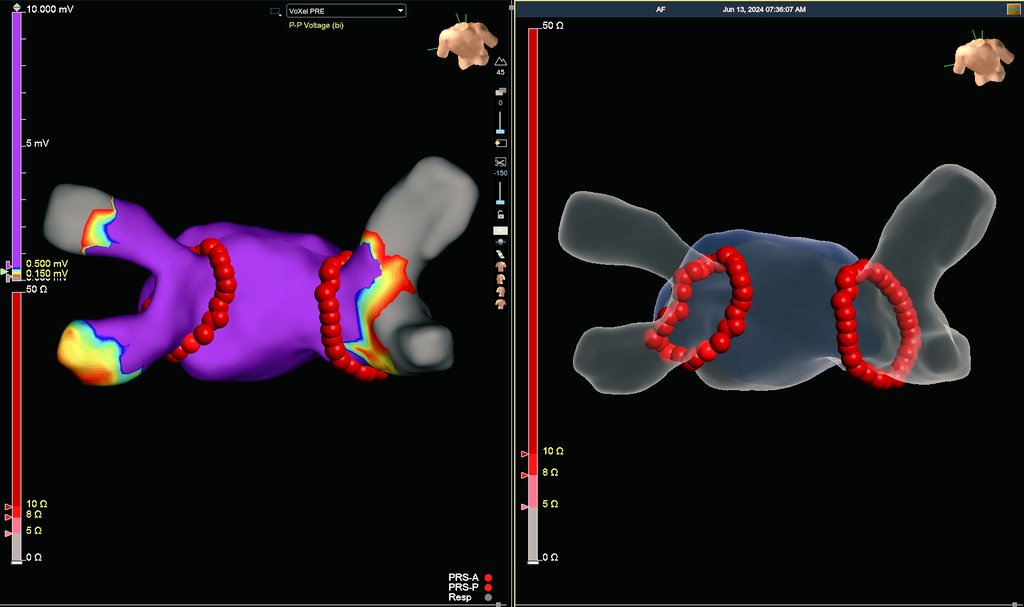 Hapa_EP's tweet photo. In this new era of PFA, there is still a certain elegance and precision to the humble RF PVI that cannot be fully duplicated. Will it become a lost art? 🎨 #EPeeps #AblateAF https://t.co/bDMKUy6Kl7