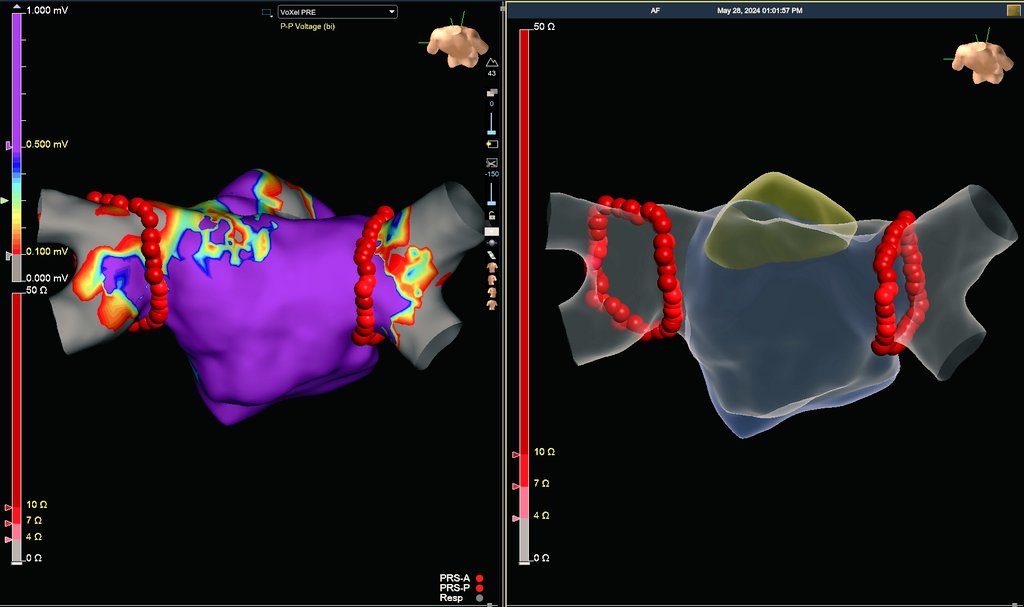 Hapa_EP's tweet photo. In this new era of PFA, there is still a certain elegance and precision to the humble RF PVI that cannot be fully duplicated. Will it become a lost art? 🎨 #EPeeps #AblateAF https://t.co/bDMKUy6Kl7