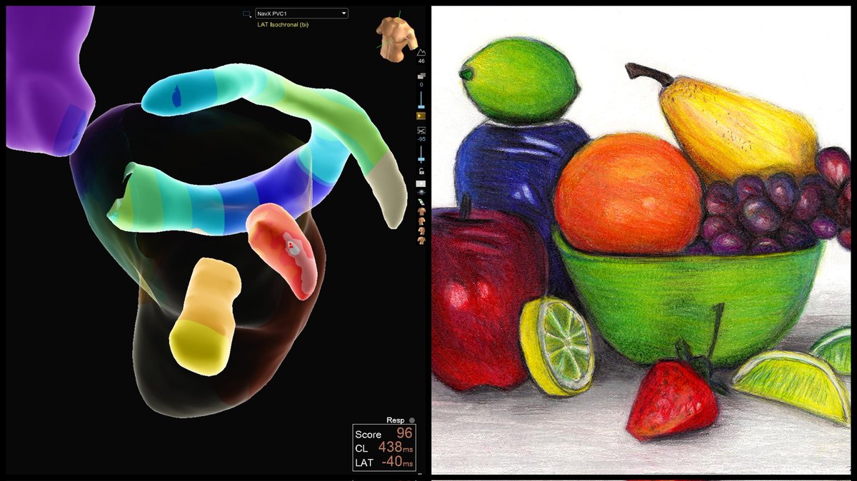 Hapa_EP's tweet photo. Papillary Muscle PVC map vs Still Life art 🖌️🎨 #EPeeps https://t.co/C7gzTe90p6