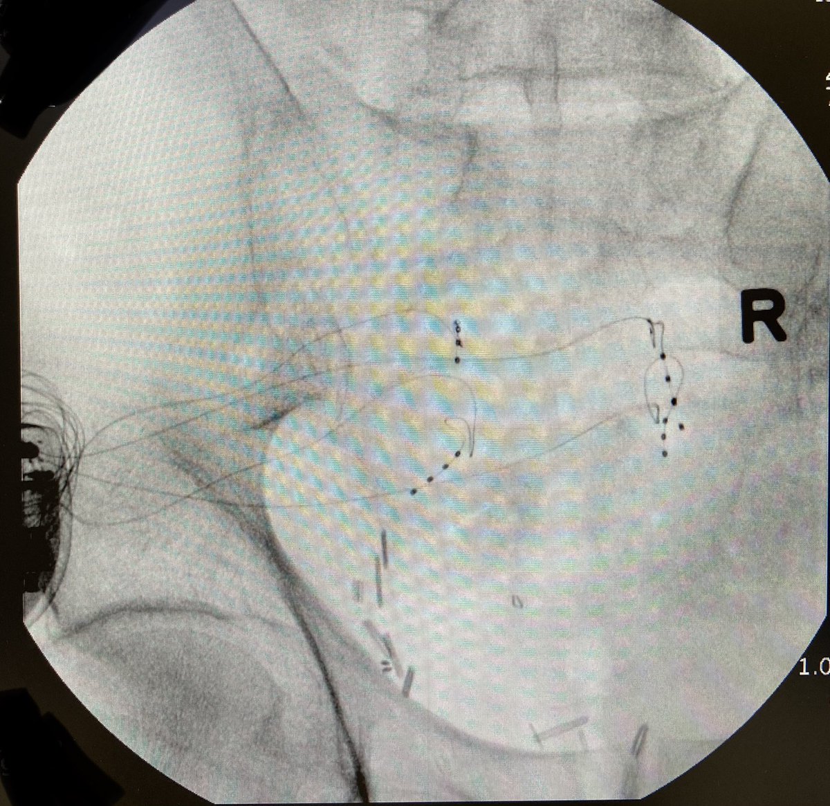 asterkawi's tweet photo. DRG stimulation is one of the most powerful technologies we have in pain medicine. My last two pelvic pain patients reported at least 70% pain relief after cutting off their pain medications. 

#Neuromodulation #DRGstimulation #ChronicPain #PainPhysician https://t.co/wlrHx3ilqO