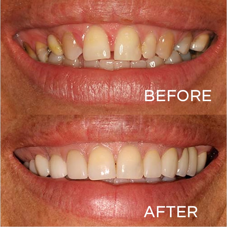 thetooth_dr's tweet photo. The before photo is of a patient with stained and spaced teeth. The after photo was achieved with dental crowns and dental whitening.
#flossdental #thetoothdr #flossboss #beforeandafter #stainedteeth #dentalwhitening #wintervilledental #oralhygiene #dentist #trinidadandtobago https://t.co/htdCTDamyv