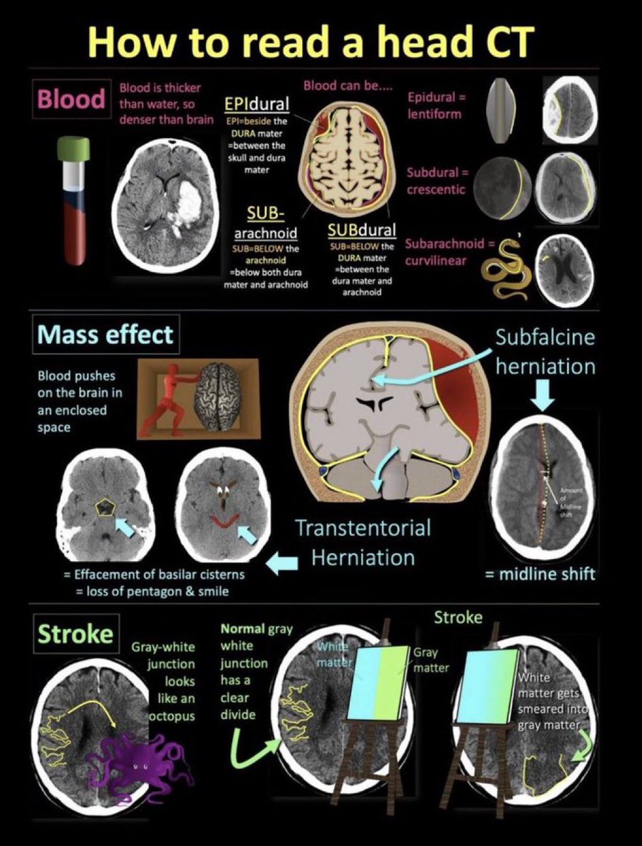 How to read a Head CT

Via <a href="/IhabFathiSulima/">Dr Ihab Suliman</a> #Meded #medx #CT