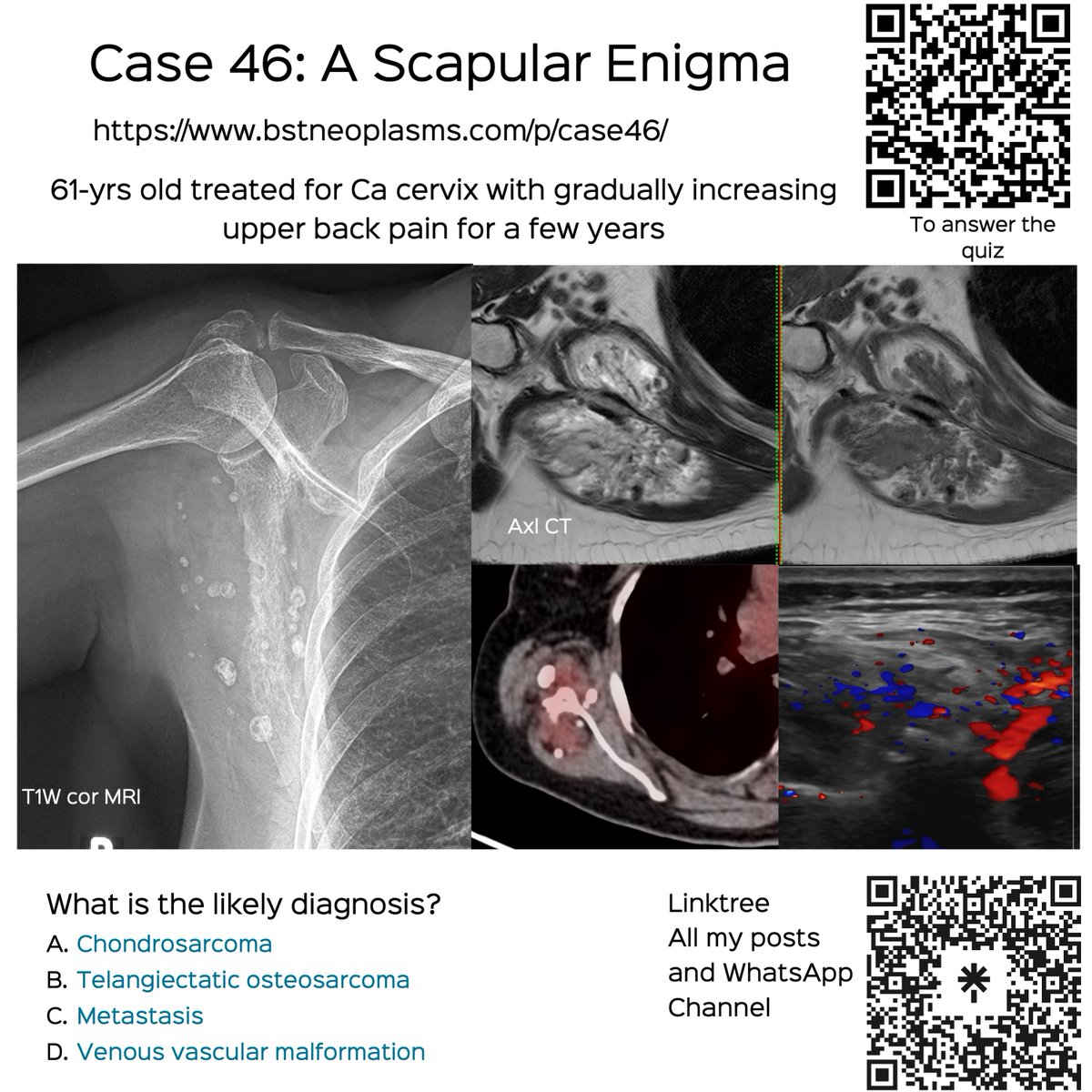 Case 46: A Scapular Enigma

61-yrs old - prior Ca cx and long standing upper back pain, gradually progressive

Thoughts?
1. Chondrosarcoma
2. Telangiectatic OGS
3. Metastasis
4. Venous vasc malformation

bstneoplasms.com/p/case46/

#bstneoplasms #radres #bonetumor #scapula