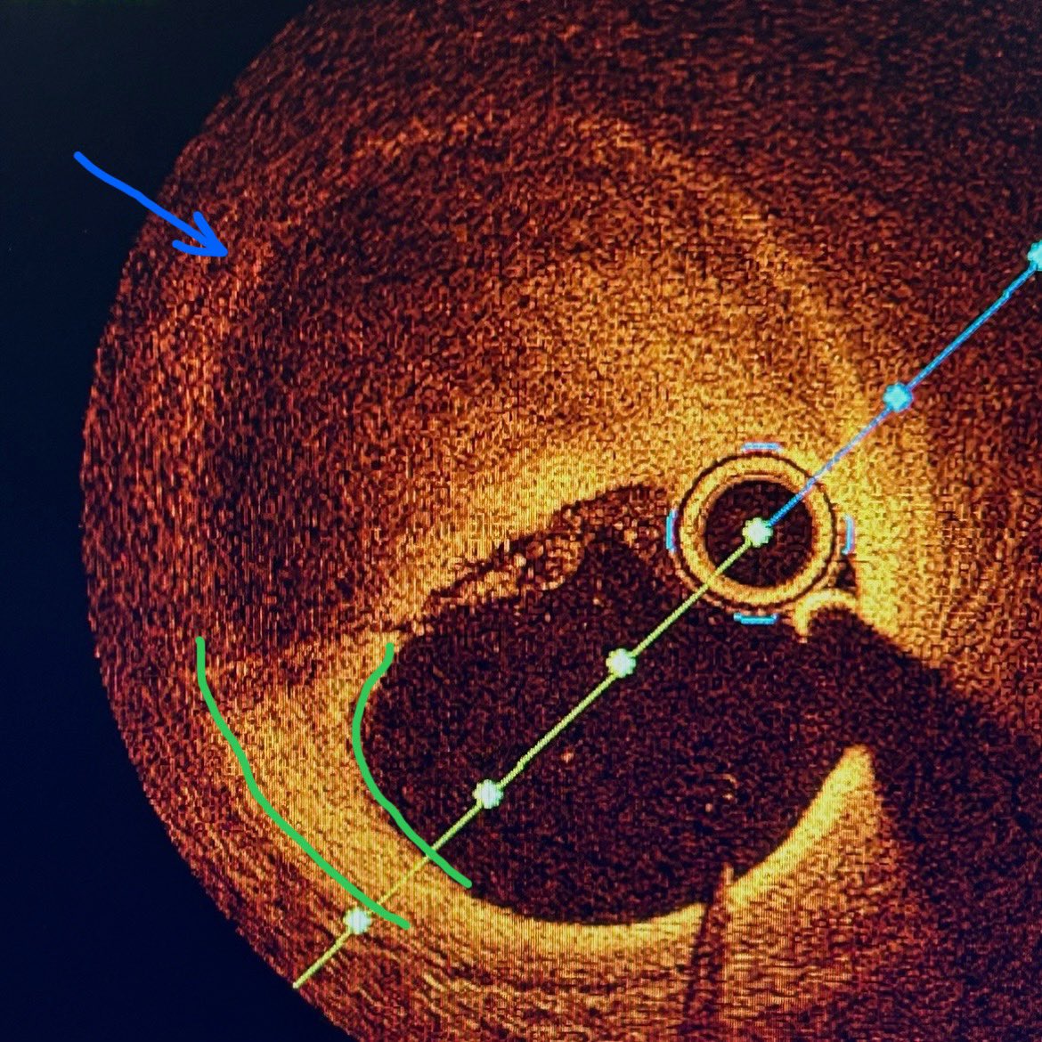 RSohnMD's tweet photo. 2/ This is intra-plaque hemorrhage (IPH), occurring inside of INTIMA

This crescent blood pool clearly resides NOT outside of media (dark stripe, blue arrow) but rather within the very eccentric fibrous plaque (green borders) https://t.co/j50GuZSIuE