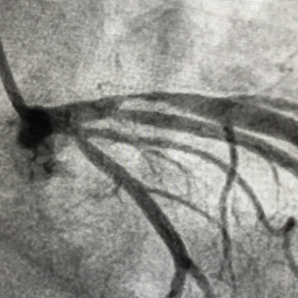 RSohnMD's tweet photo. 2/ This is intra-plaque hemorrhage (IPH), occurring inside of INTIMA

This crescent blood pool clearly resides NOT outside of media (dark stripe, blue arrow) but rather within the very eccentric fibrous plaque (green borders) https://t.co/j50GuZSIuE