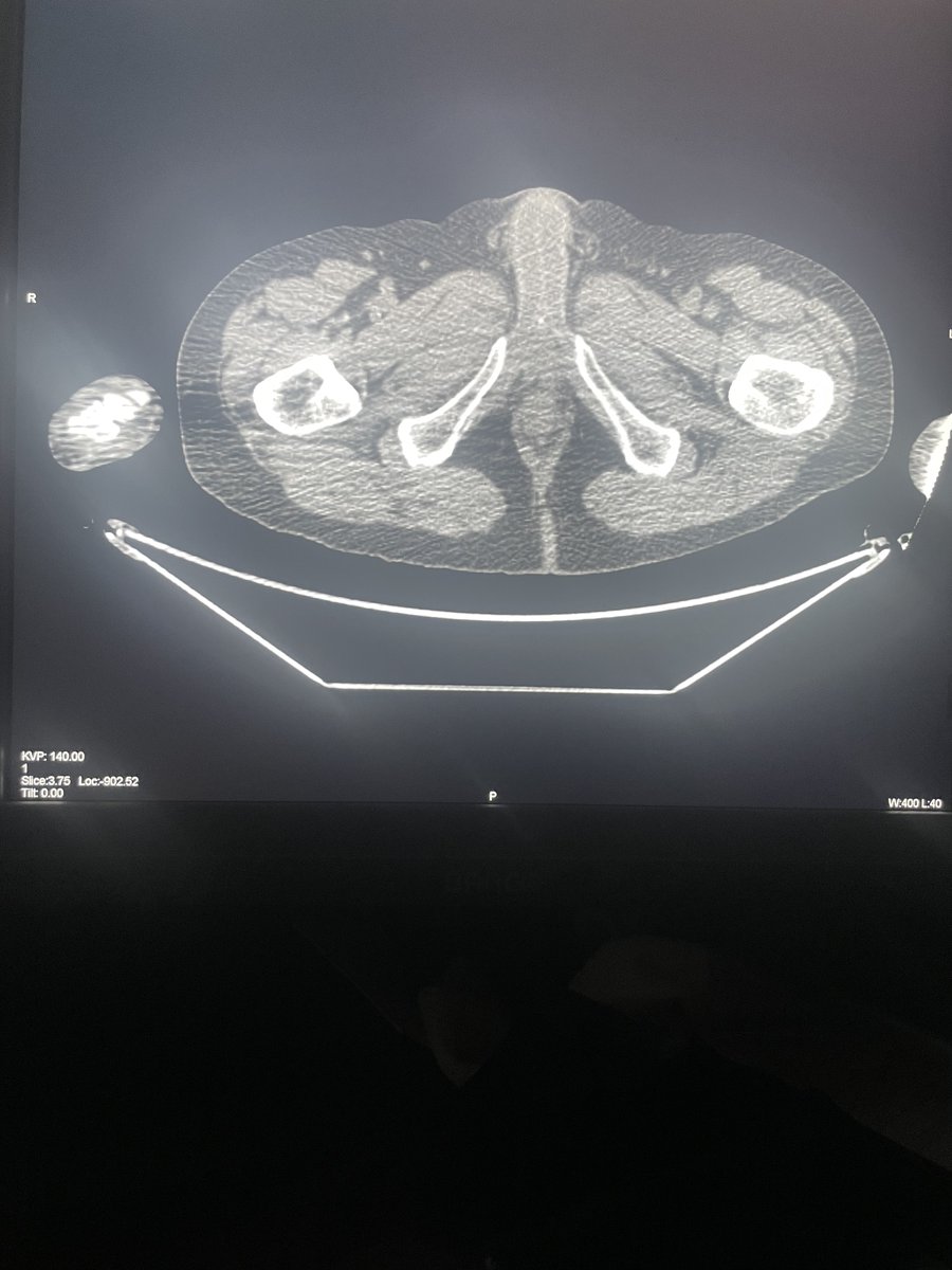 bejit1's tweet photo. https://t.co/GzshR6Azdn Case of the Week From 6/16/24

History: Difficulty urinating. First film from today. Second film from 2 years ago.
Where is the calcification? 
What is the differential? 
What is the next step? 
https://t.co/oll46nLzb6
#Ctscan #pelvis #urethra #calculus https://t.co/Wg5ymhOZqQ