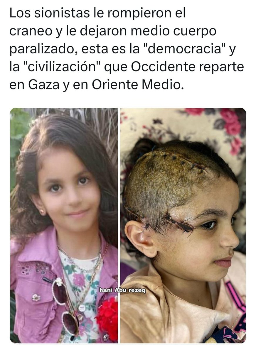 Distrito182's tweet photo. @plexaleOK Pues a mí me parece que peinándose un poco no esta mal, no como esta niña que la rpmpisteis el craneo y tiene parálisis del todo el lado izquierdo de por vida 🤨 https://t.co/usdRZtKNa7