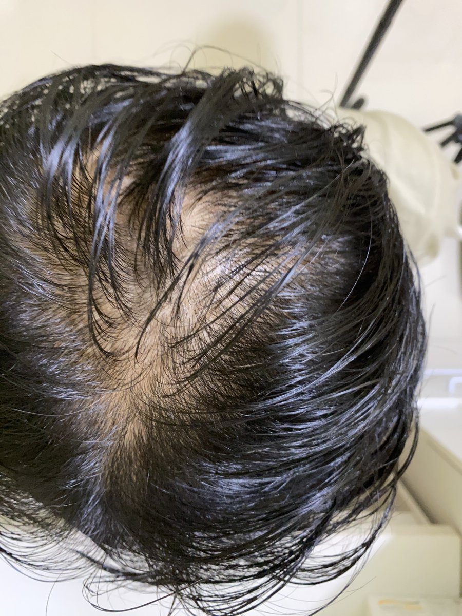 andihiyat's tweet photo. GUA MAU CERITA PENGALAMAN PERTAMA KE CLINIC BUAT KONSUL DAN TREATMENT RAMBUT

Tau ngga knp gua potong rambut pendek? Karna rambut gua rontok bgt dan gua takut kebotakan dini 😭

Hampir putus asa udah coba banyak produk tapi masih rontok juga, akhirnya gua beraniin diri ke clinic https://t.co/wUfsEBi6h8