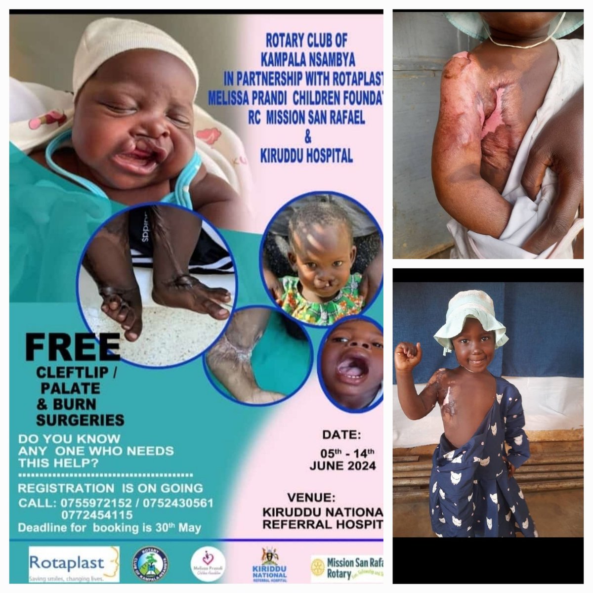 JayMallow Foundation (@jaymallowf) on Twitter photo Thank you <a href="/rcnsambya/">RC Kampala Nsambya</a>, <a href="/kirudduNRH/">KIRUDDU NATIONAL REFERRAL HOSPITAL</a> and partners for the burn surgery you performed on baby Success for FREE! She can now move her arm and is recovering well. May God richly bless you.
<a href="/DeRugaju77153/">Martin Rugaju</a> <a href="/joanproverbs/">atuhaire joan</a> <a href="/TusiimeRonah2/">@Tusiime Ronah</a> <a href="/OjUganda/">OJ Disability Care Foundation (OJCARE)</a> <a href="/AlexOgwal5/">Alex Ogwal</a> <a href="/AfriChildCentre/">The AfriChild Centre</a> Thank you <a href="/rcnsambya/">RC Kampala Nsambya</a>, <a href="/kirudduNRH/">KIRUDDU NATIONAL REFERRAL HOSPITAL</a> and partners for the burn surgery you performed on baby Success for FREE! She can now move her arm and is recovering well. May God richly bless you.
<a href="/DeRugaju77153/">Martin Rugaju</a> <a href="/joanproverbs/">atuhaire joan</a> <a href="/TusiimeRonah2/">@Tusiime Ronah</a> <a href="/OjUganda/">OJ Disability Care Foundation (OJCARE)</a> <a href="/AlexOgwal5/">Alex Ogwal</a> <a href="/AfriChildCentre/">The AfriChild Centre</a>