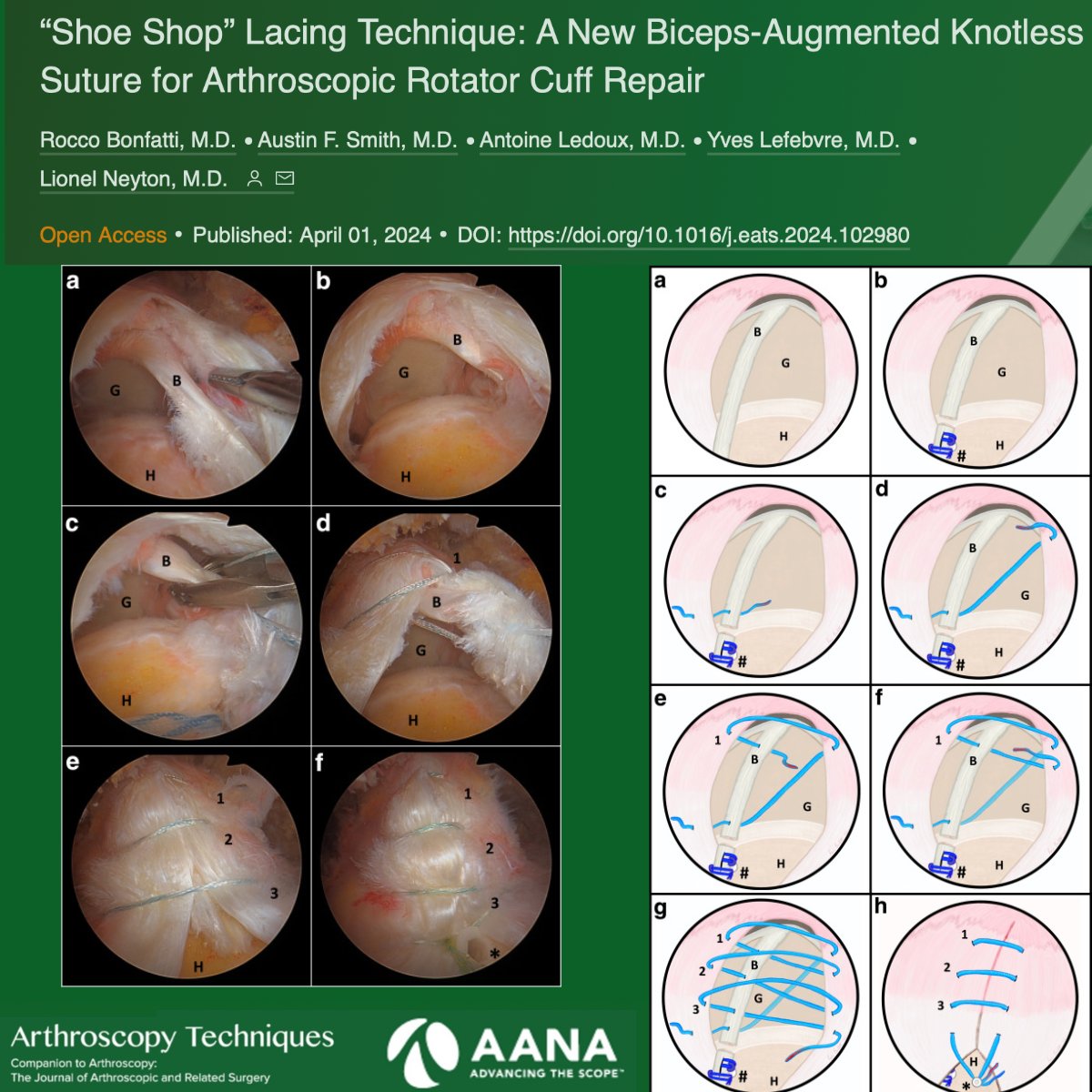A cool option for tying in the biceps for large cuff tears #rct #cuffrepair
ow.ly/x5CS50SeHyI