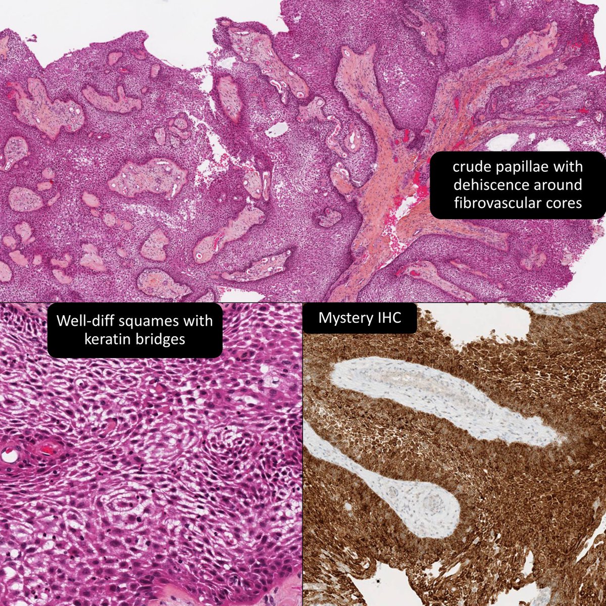 DrCycloPath's tweet image. Almost all ____ craniopharyngiomas demonstrate ___
a) papillary
b) adamantinomatous
#NeuroPath #PathTwitter #PathResidents #Pathology
🔬lmpimg.med.utoronto.ca/LMP80549.htm?u…