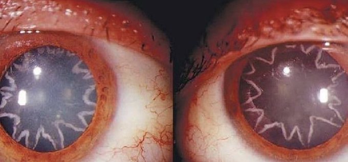fasc1nate's tweet photo. The eyes of an electrician after being zapped by 14,000 volts of electricity.    

His shoulder touched a live wire and the current passed through his entire body, including the optic nerve, which connects the eye to the brain.     

The effect was two bizarre star-shaped electrical burns in his eyes, according to The New England Journal of Medicine.