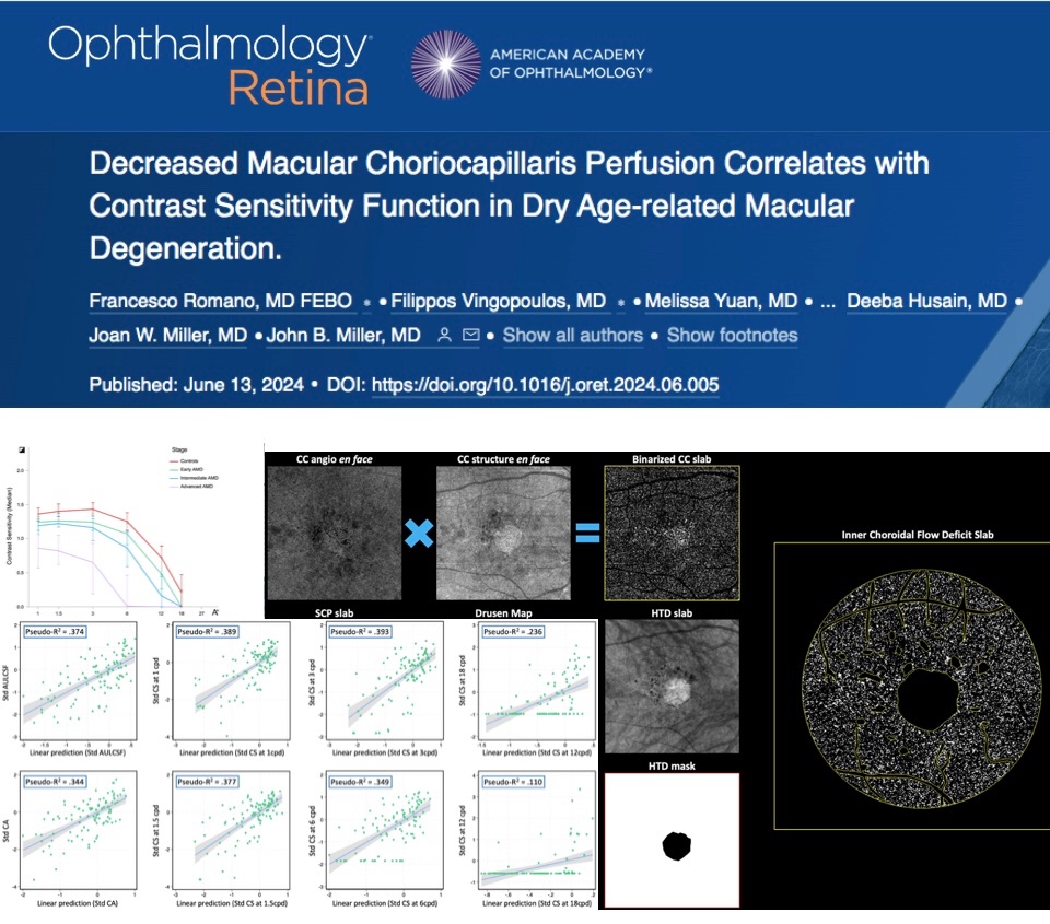 Filippos Vingopoulos, MD (@fvingopoulos) on Twitter photo Thrilled to publish at <a href="/AAOjournal/">Ophthalmology</a> our work from <a href="/HMSeye/">Harvard Ophthalmology</a>/<a href="/MassEyeAndEar/">Mass Eye and Ear</a> on decreased choriocapillaris perfusion and #qCSF contrast sensitivity in dry #AMD. Great team work with Fr. Romano, <a href="/VavvasRetina/">Demetrios G Vavvas</a> <a href="/JohnBMillerMD/">John B. Miller</a>
ophthalmologyretina.org/article/S2468-…
#Retina #Ophthalmology Thrilled to publish at <a href="/AAOjournal/">Ophthalmology</a> our work from <a href="/HMSeye/">Harvard Ophthalmology</a>/<a href="/MassEyeAndEar/">Mass Eye and Ear</a> on decreased choriocapillaris perfusion and #qCSF contrast sensitivity in dry #AMD. Great team work with Fr. Romano, <a href="/VavvasRetina/">Demetrios G Vavvas</a> <a href="/JohnBMillerMD/">John B. Miller</a>
ophthalmologyretina.org/article/S2468-…
#Retina #Ophthalmology