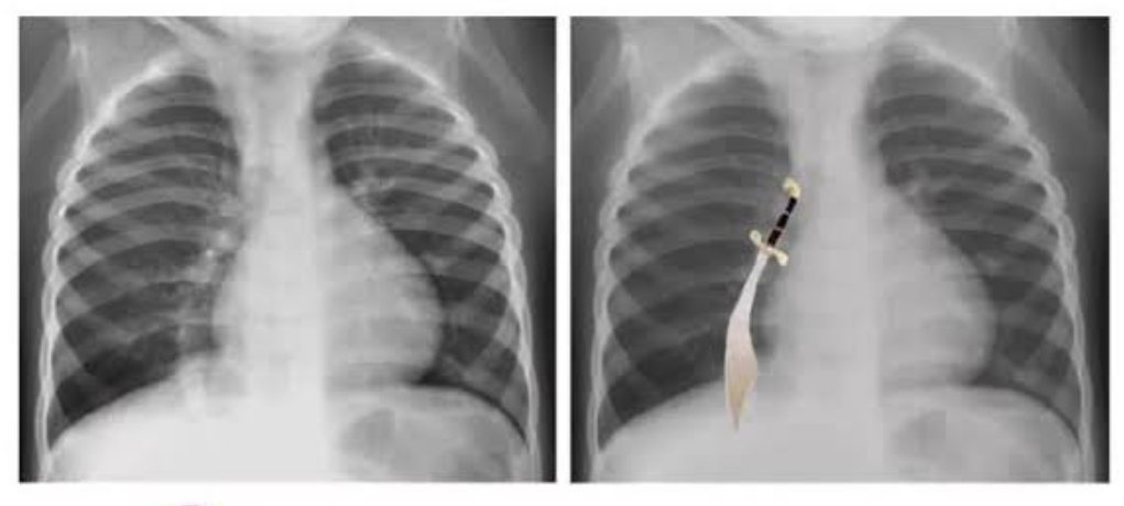 LaLoTomas3's tweet image. La dextroposición 🫀 es un dato radiográfico que debe hacernos sospechar hipoplasia pulmonar derecha 🫁 y si esto se asocia a conexión anómala parcial de venas pulmonares, habremos integrado el Sindrome de la Cimitarra 🗡️ #CardioPedMx