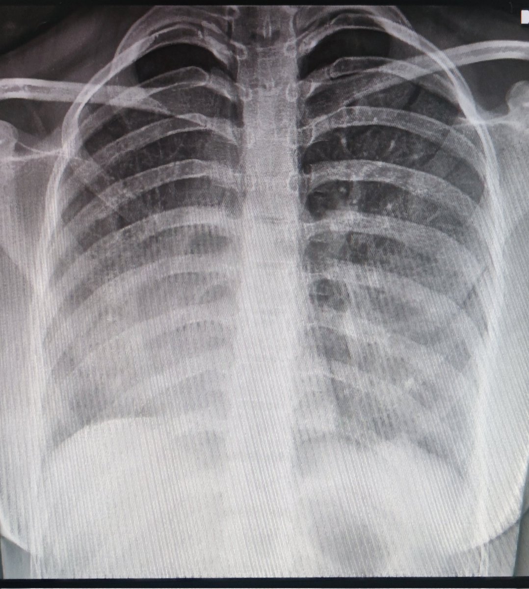 LaLoTomas3's tweet image. La dextroposición 🫀 es un dato radiográfico que debe hacernos sospechar hipoplasia pulmonar derecha 🫁 y si esto se asocia a conexión anómala parcial de venas pulmonares, habremos integrado el Sindrome de la Cimitarra 🗡️ #CardioPedMx