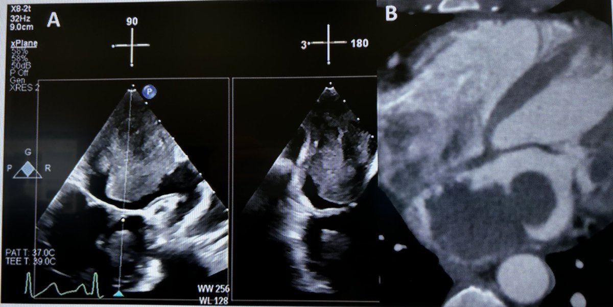 Gary Huang, MD (@garyshuang) on Twitter photo Outstanding posters by former co-fellow <a href="/md_neda/">Neda Dianati, MD, MSc, FACC</a> of a patient with post-STEMI pseudoaneurysm, and by former residents and current fellows <a href="/AndrewPattock/">Andrew Pattock</a> and @cooperbkersey of massive intracardiac metastasis!
<a href="/StonyBrookMed/">Stony Brook Medicine</a> <a href="/uwashfellows/">Univ. of Washington Cardiology Fellows</a> <a href="/UWMedHeart/">UWashington Heart Institute</a> <a href="/ASE360/">American Society of Echocardiography</a> #ASE2024 #EchoFirst Outstanding posters by former co-fellow <a href="/md_neda/">Neda Dianati, MD, MSc, FACC</a> of a patient with post-STEMI pseudoaneurysm, and by former residents and current fellows <a href="/AndrewPattock/">Andrew Pattock</a> and @cooperbkersey of massive intracardiac metastasis!
<a href="/StonyBrookMed/">Stony Brook Medicine</a> <a href="/uwashfellows/">Univ. of Washington Cardiology Fellows</a> <a href="/UWMedHeart/">UWashington Heart Institute</a> <a href="/ASE360/">American Society of Echocardiography</a> #ASE2024 #EchoFirst