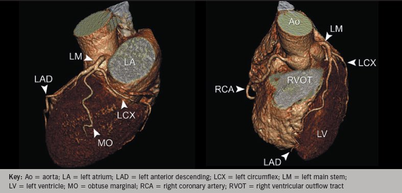 📌Common angiographic projections for coronary artery assessment 

Check this 🧵 for each artery view👇🏼

Make sure to share &amp; bookmark‼️