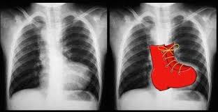 LaLoTomas3's tweet image. La imagen radiográfica en zapato zueco (sueco) 🥾🇳🇱 o en botita 👢es característica de la Tetralogía de Fallot o de la Atresia Pulmonar #T4F #AP #CardioPedMx
