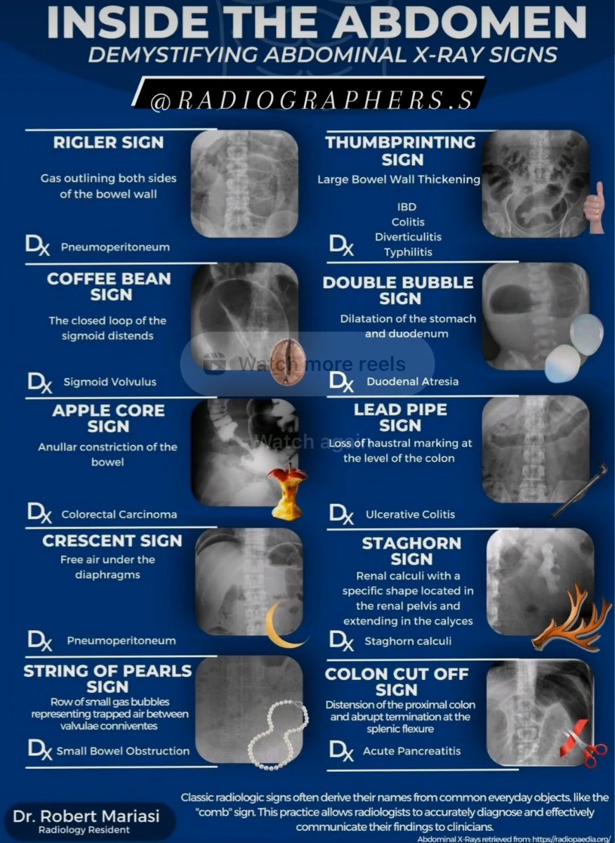 imedverse's tweet photo. Abdominal X-RAY signs

Credit: radiographers.s #meded #medx https://t.co/zj5SgRy4nE