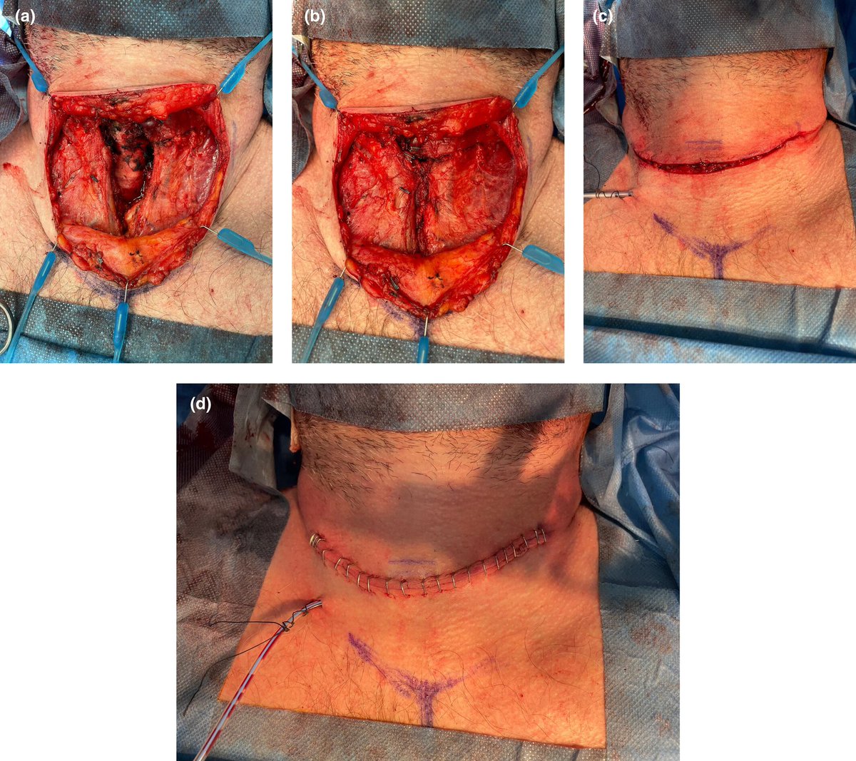 Anaes_Journal's tweet photo. Do you know what to do in the case of a life-threatening #thyroid haematoma?

SCOOP
• expose Skin
• Cut sutures
• Open skin
• Open muscles
• Pack wound

BUT if the neck wound is closed with skin glue, step 3 may be required BEFORE step 2!

🔗https://t.co/EkzBnDVBB9 https://t.co/OiAsKeu4PN