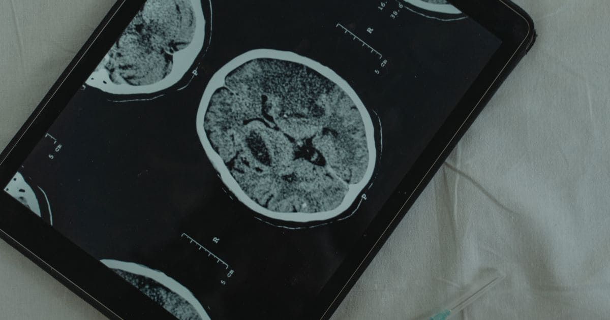 [Actu santé💚]

Les chercheurs et médecins ont découvert une nouvelle méthode permettant de stimuler les profondeurs du cerveau humain sans chirurgie ⁉️ Afin d'en apprendre plus sur le striatum. Cette zone joue un rôle crucial dans la motricité automatique 🧠 

#cerveau #medecine