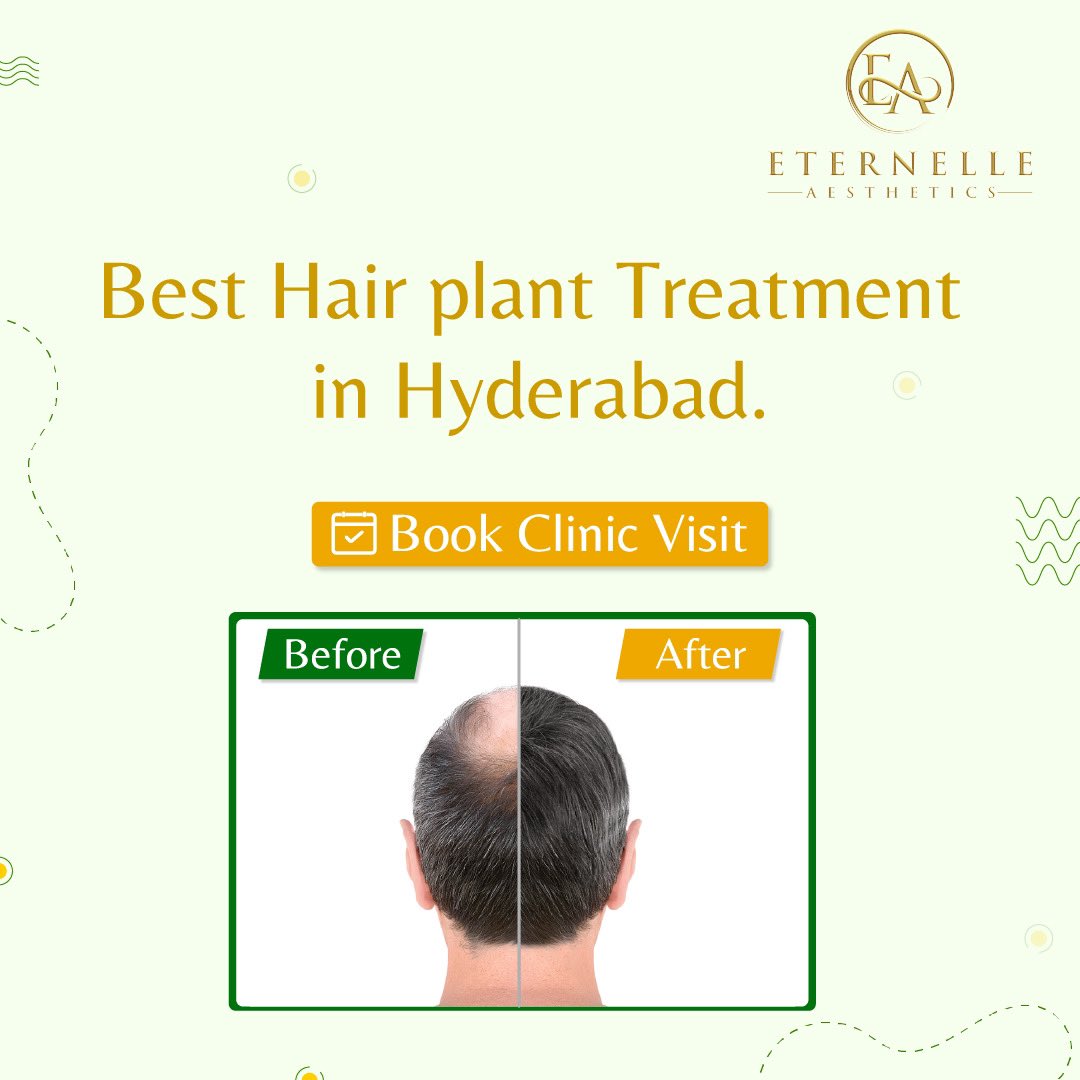 Eternelle_'s tweet photo. Experience the magic of our hair treatment and enjoy the confidence that comes with beautiful, revitalized hair!

📲094594 55888

#HairTransplant #HairRestoration #HairTransplantSurgery #HairTransplantResults #HairTransplantClinic #HairLossTreatment #HairGrowth https://t.co/Xbchbzdow9