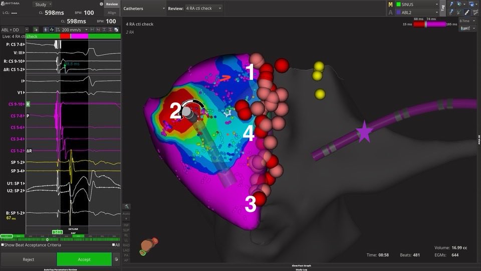 Challenging CTI line, no block in spite of substantial effort.  Pacing proxCS (star) gives this activation map from LAO caudal view.   Red early,purple late.  Where to target next?  Answer ultimately in replies