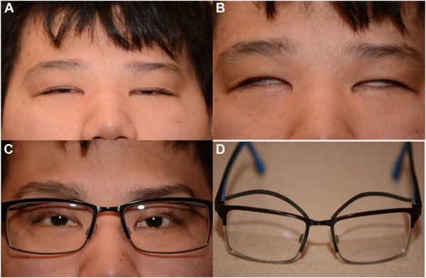 Ptosis Crutches: An Eye Opening Solution
ow.ly/EwHZ50RAiKS 
#ophthalmology