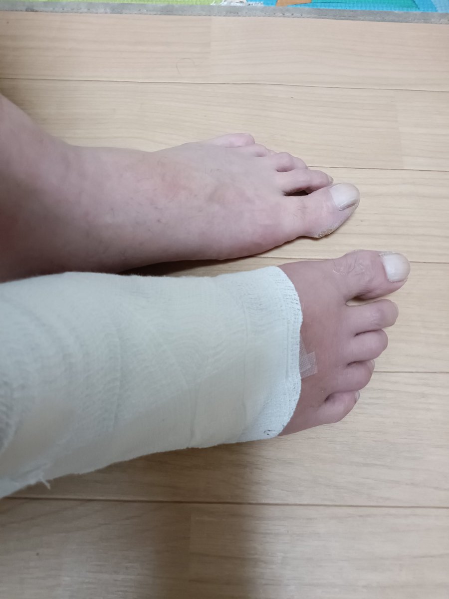 お疲れさまですーーー
労災19日目ーーー
壊死部分の抜糸も先週末おわりました！(￣▽￣;)
先生いわく　回復力遅いみたい(-_-;)
患部写メしたので見たい方DMもらえれば送ります(-_-;)
グロ注意！(￣▽￣;)