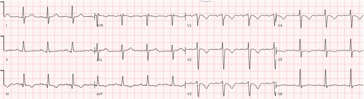 Another deadly triage ECG missed, and the waiting patient leaves before being seen. What is this nearly pathognomonic ECG?

hqmeded-ecg.blogspot.com/2024/06/anothe…