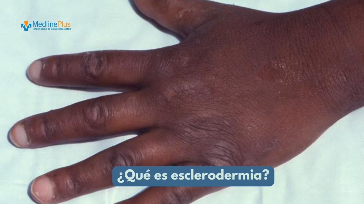MedlinePlusEsp's tweet image. Esclerodermia significa "piel dura". Es una enfermedad autoinmune que causa inflamación y engrosamiento de la piel y otras partes del cuerpo. ¿Por qué ocurre? Eso y más en el enlace ow.ly/QnTW50SiMxS #SclerodermaAwarenessMonth