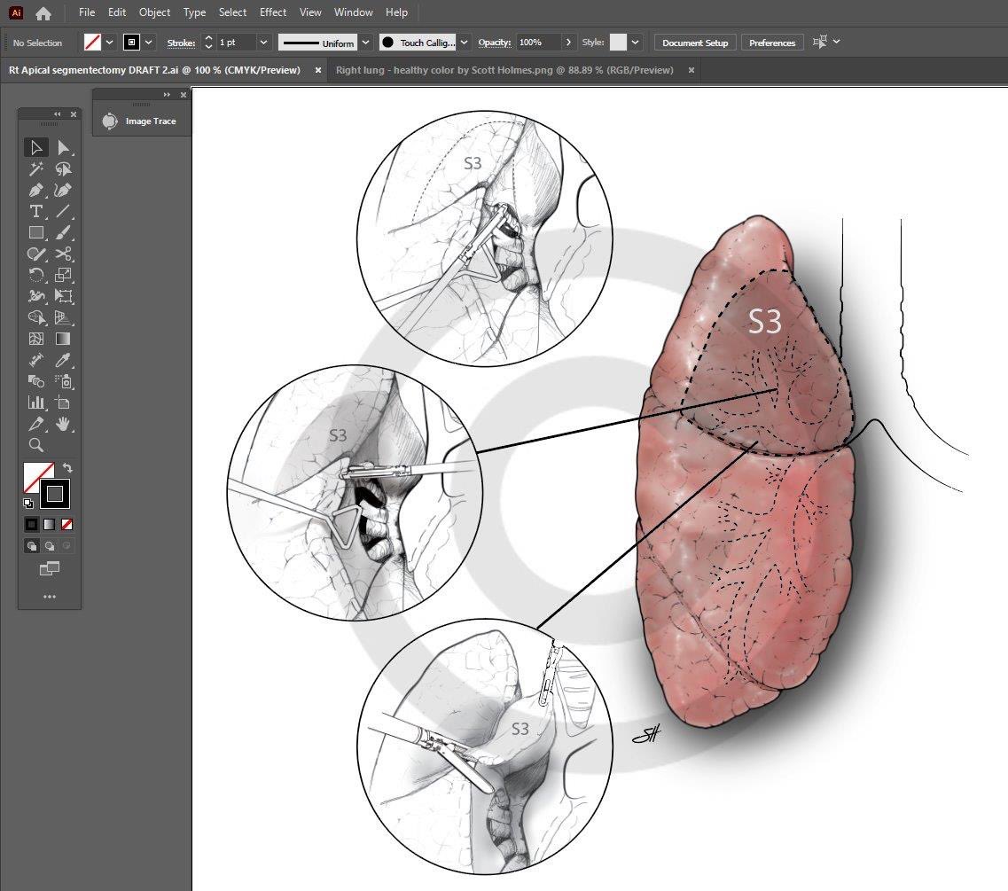 In the works. Right segmentectomy <a href="/ShandaBlackmon/">Shanda Blackmon, MD, MPH</a> <a href="/BCM_Thoracic/">David J. Sugarbaker Division of Thoracic Surgery</a>