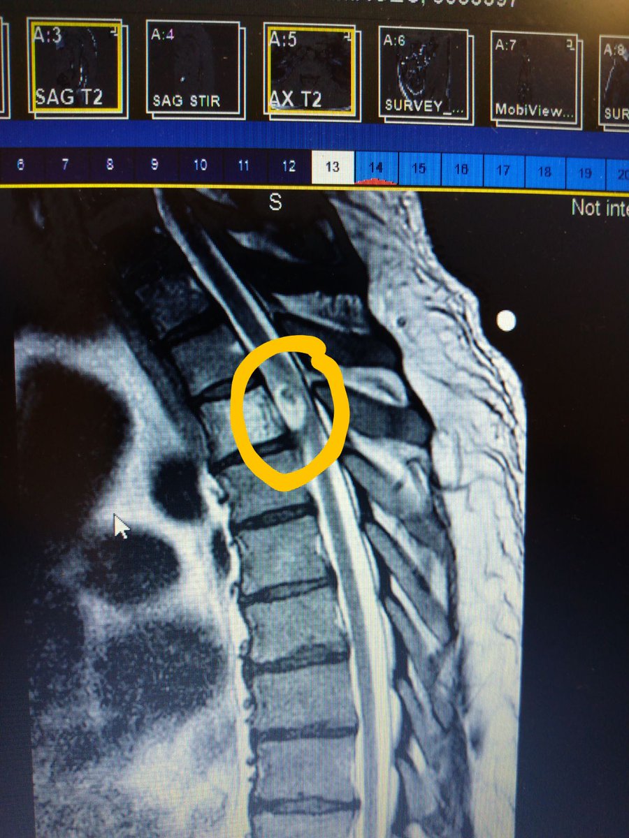 UNCneurosurgery's tweet photo. NC #veteran Butch had always been active, working as a plumber post military. But a #SpineTumor compressing his #spine caused numbness from the chest down &amp; almost left him paralyzed. @CheeragU removed the rare #tumor @UNC_Health_Care: https://t.co/OhCMbDFuWx https://t.co/tO3w1LAbuj