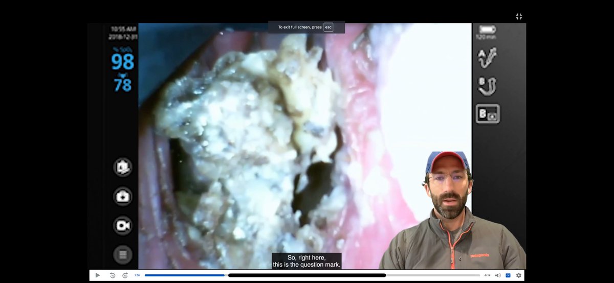 Andrew Pirotte (@apirotte) on Twitter photo June 2024 Airway of the Month! Large foreign body overlying glottis. DuCanto? Magill? Email me if you need access (free/open access)! Apirotte@kumc.edu
kumc.hosted.panopto.com/Panopto/Pages/…
<a href="/jducanto/">James DuCanto, M.D.</a> <a href="/TBayEDguy/">Yen Chow</a> <a href="/AirwayMxAcademy/">Hans Huitink</a> @dastrainees <a href="/ProtectedAirway/">The Protected Airway Collaborative</a> <a href="/JohnCSakles/">AirwayMan</a> <a href="/AirwayOnDemand/">Will Rosenblatt, MD</a> June 2024 Airway of the Month! Large foreign body overlying glottis. DuCanto? Magill? Email me if you need access (free/open access)! Apirotte@kumc.edu
kumc.hosted.panopto.com/Panopto/Pages/…
<a href="/jducanto/">James DuCanto, M.D.</a> <a href="/TBayEDguy/">Yen Chow</a> <a href="/AirwayMxAcademy/">Hans Huitink</a> @dastrainees <a href="/ProtectedAirway/">The Protected Airway Collaborative</a> <a href="/JohnCSakles/">AirwayMan</a> <a href="/AirwayOnDemand/">Will Rosenblatt, MD</a>